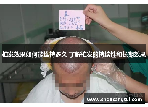 植发效果如何能维持多久 了解植发的持续性和长期效果 植发效果如何能维持多久 了解植发的持续性和长期效果